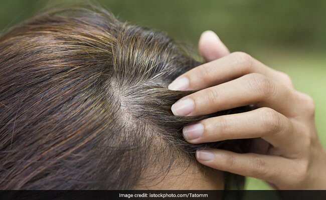 How To Get Rid Of White Hair: सफेद बालों को काला करने के लिए जबरदस्त हैं 3 आयुर्वेदिक चीजें, जल्द दिखेगा असर!