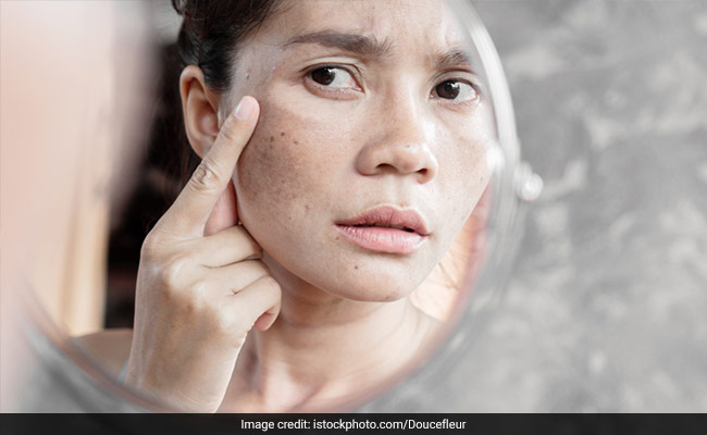 How To Remove Dark Spots From Face Naturally