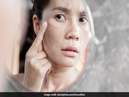 How To Remove Dark Spots From Face Naturally How To Remove Dark Spots From Face Naturally