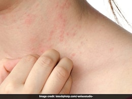 एक्जिमा से राहत पाने के लिए ब्लीच बाथ कितना फायदेमंद है? जानिए Eczema Patients कैसे कर सकते हैं ब्लीच बाथ