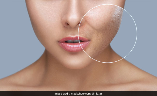 How To Remove Scars Of Pimples From Face: Follow These Acne Scar Removal Tips