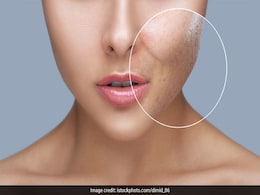 How To Remove Scars Of Pimples From Face: Follow These Acne Scar Removal Tips How To Remove Scars Of Pimples From Face: Follow These Acne Scar Removal Tips