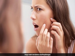 10 Home Remedies For Pimples: Keep Your Skin Flawless Naturally 10 Home Remedies For Pimples: Keep Your Skin Flawless Naturally