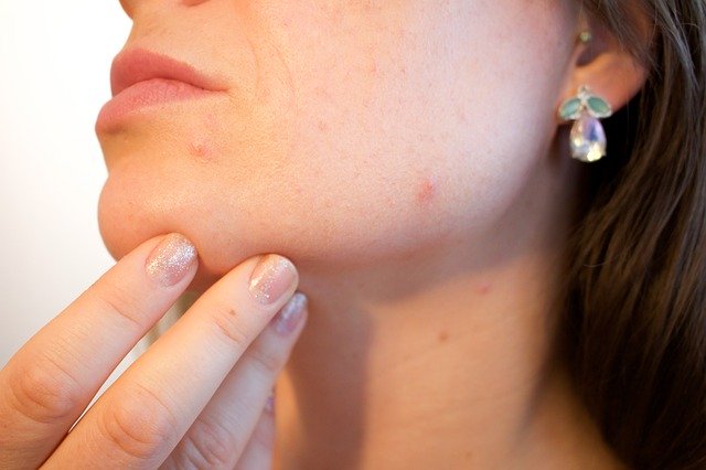 Wearing an unlcean face mask can also be contributing to acne