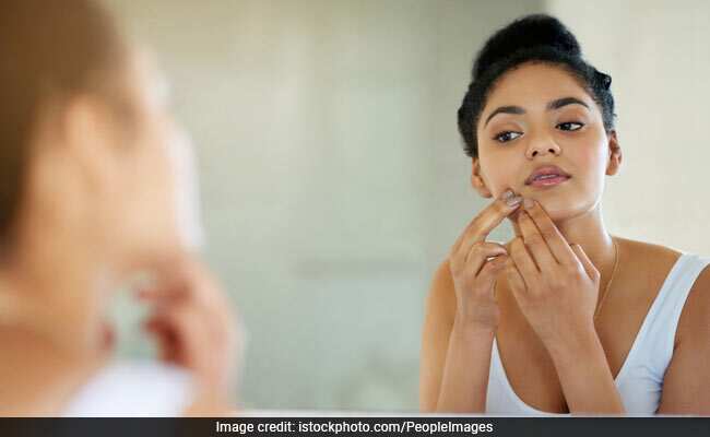Home Remedies For Acne: पिंपल्स से छुटकारा पाने के लिए ये दो चीजें हैं रामबाण उपाय, जानें चेहरे पर लगाने का तरीका!