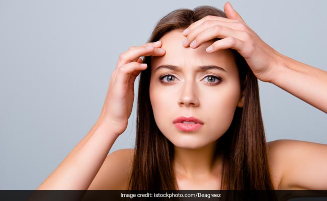 Zinc For Acne: Here's How It Can Do Wonders To Your Skin; Know How To Use It Safely From Expert