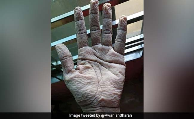 10 घंटे लगातार काम करने के बाद ऐसे हो गए डॉक्टर के हाथ, IAS अफसर बोले- 'हीरो को सलाम...'