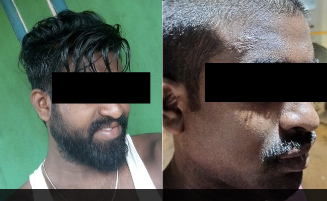 Dalit Man Beaten, Head Shaved Allegedly By Andhra Cops On MLA's Prodding