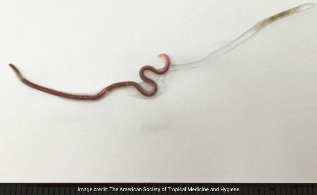 She Went To Doctors With Sore Throat. They Found Live Worm In Her Tonsils