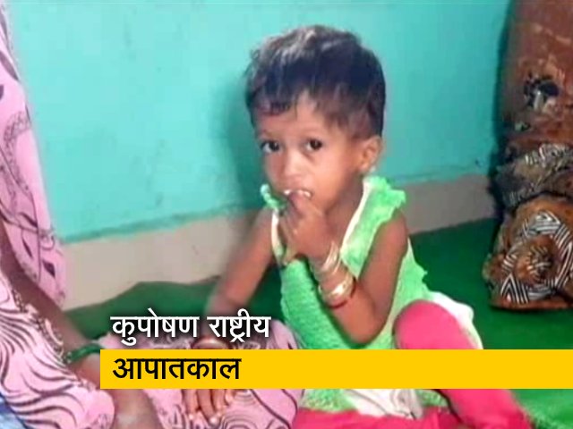 पोषण भारत कार्यक्रम : कुपोषण हमारे देश की बड़ी समस्या