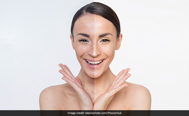 मेकअप से मुंहासों के निशान छिपाने के लिए फॉलो करें ये आसान टिप्स