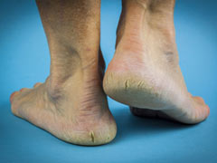 How To Remove Dead Skin: अपने पैरों से डेड स्किन को हटाने के लिए 6 आसान घरेलू नुस्खे