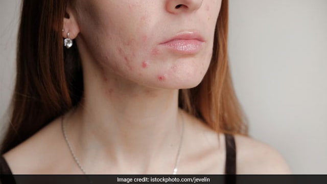 Skincare tips: Wear less make up to prevent breakouts due to masks