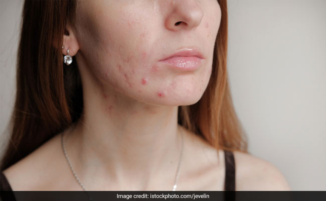 Skincare tips: Wear less make up to prevent breakouts due to masks