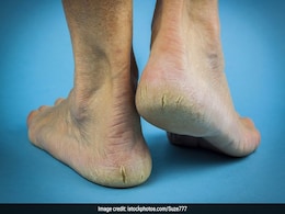 Tips For Cracked Heels: फटी एड़ियों को कोमल बनाने के लिए अपनाएं ये घरेलू नुस्खे Tips For Cracked Heels: फटी एड़ियों को कोमल बनाने के लिए अपनाएं ये घरेलू नुस्खे