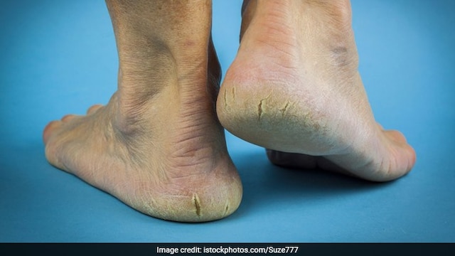 Cracked heels may be due to multiple reasons including ageing and walking barefoot
