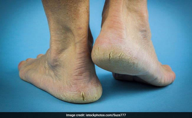 Cracked heels may be due to multiple reasons including ageing and walking barefoot