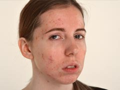 PMS acne? क्या होते हैं हार्मोनल एक्ने, कैसे करें इनसे बचाव, एक्सपर्ट से जानें