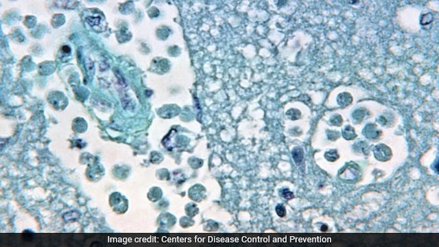 Scientists Warn Of Increasing Public Health Risks From Free-Living Amoebae
