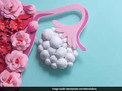 Is PCOS A Lifestyle Disorder Or Genetic? Gynecologist Answers