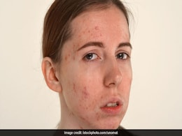 Cystic Acne से छुटकारा पाने के लिए बहुत फायदेमंद हैं ये 6 आसान घरेलू नुस्खें Cystic Acne से छुटकारा पाने के लिए बहुत फायदेमंद हैं ये 6 आसान घरेलू नुस्खें