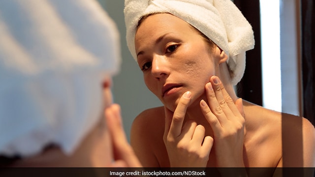 By consistently following these hacks, you can gradually reduce the appearance of acne scars