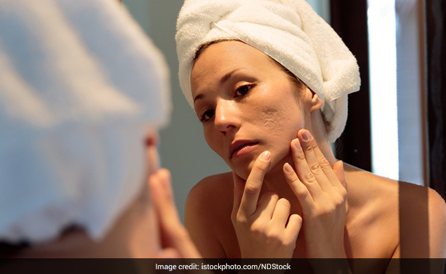 Atrophic acne scars are also known as depressed scars