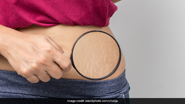 How to Remove Stretch Marks: 7 Effective Natural Remedies