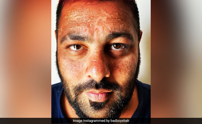 बादशाह के चेहरे का हुआ ऐसा हाल, रैपर ने शेयर की Photo तो आ गई रिएक्शन की बाढ़