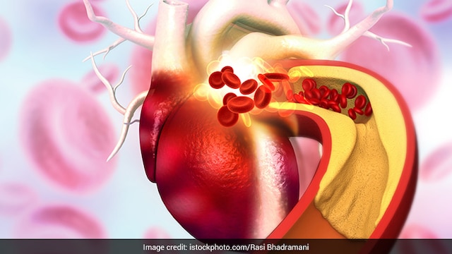 Reduce consumption of processed foods to keep your cholesterol levels healthy