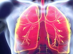 World Lung Cancer Day: Doctor Explains Why Lung Cancer In Non-Smokers Is On The Rise