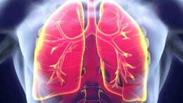 World Lung Cancer Day: Doctor Explains Why Lung Cancer In Non-Smokers Is On The Rise