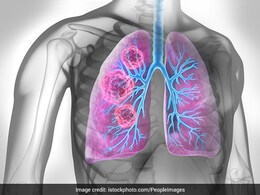 फेफड़ों का कैंसर - लक्षण, कारण, उपचार और रोकथाम