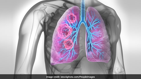 Understanding The Silent Nature Of Early-Stage Lung Cancer: Why Patients Often Present At Stage 4