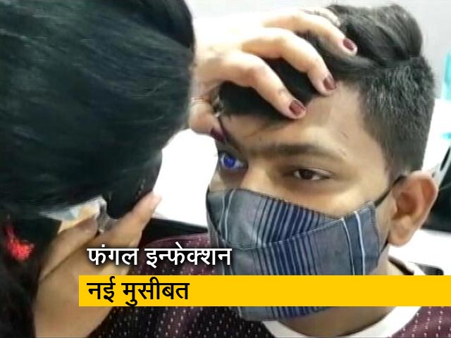 कोरोना के मरीजों के लिए जानलेवा बन रहा फंगल इन्फेक्शन