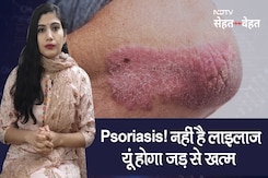 सोराइसिस : कारण, प्रकार, इलाज और बचाव सोराइसिस : कारण, प्रकार, इलाज और बचाव