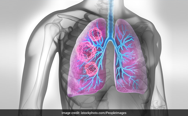 Smoking can lead to Idiopathic pulmonary fibrosis