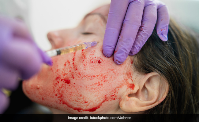 Would You Dare To Get A Vampire Facial? Here's What You Need To Know About It