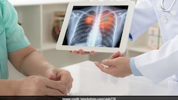 How To Detect Lung Pneumothorax At Early Stages