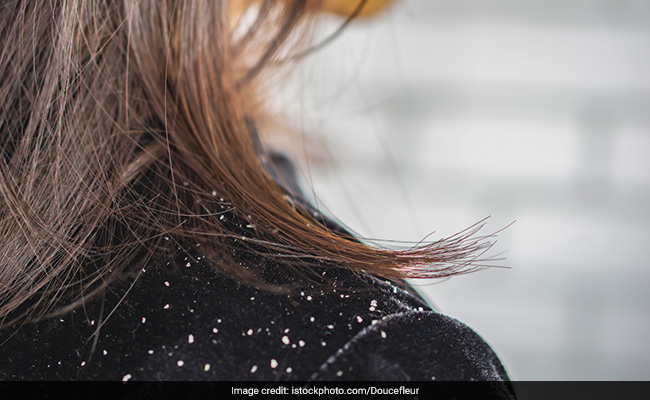 Be Warned: These Hair Care Mistakes Might Be The Cause Of Your Dandruff