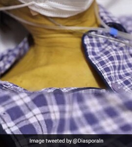 How Excessive Smoking Caused A Man's Skin To Turn Yellow