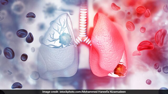 Treatment of interstitial lung disease is aimed at improving patient's quality of life