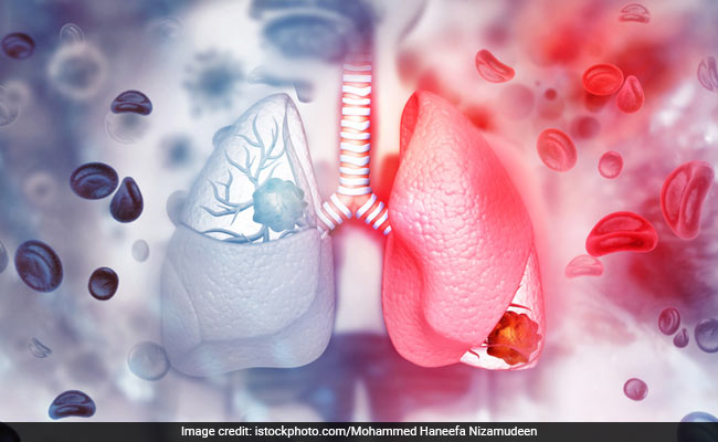 Treatment of interstitial lung disease is aimed at improving patient's quality of life