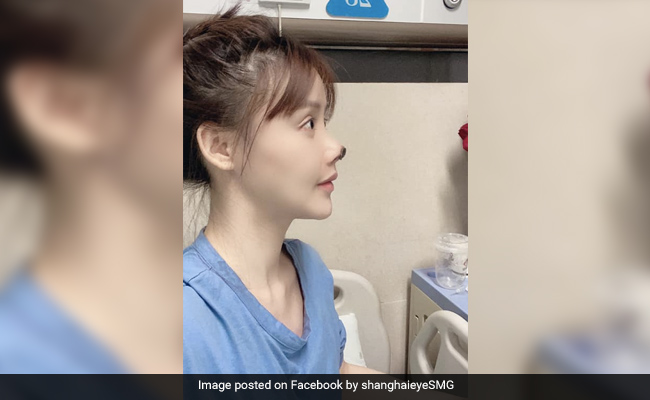 Chinese Star Gao Liu Shares Shocking Pics Of Botched Nose Surgery