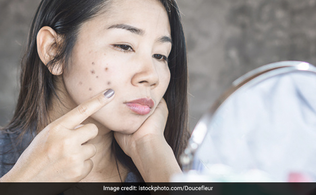Treat Your Dark Spots At Home With These Natural DIY Remedies