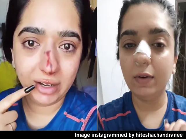 Bengaluru Woman Alleges Zomato Delivery Man Hit Her, Shows Bloody Nose