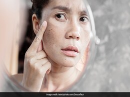 Here's How You Can Fight Pigmentation And Improve Skin Health: Expert Tips Here's How You Can Fight Pigmentation And Improve Skin Health: Expert Tips