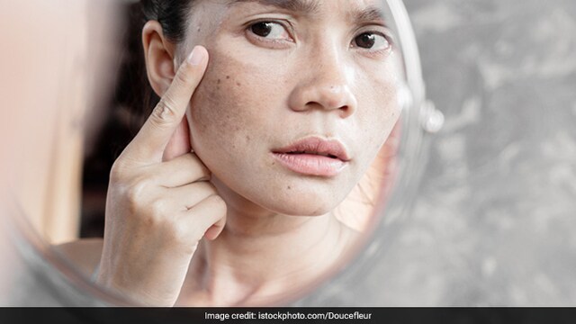 Here's How You Can Fight Pigmentation And Improve Skin Health: Expert Tips