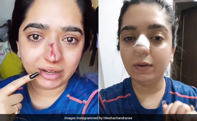 Bengaluru Woman Alleges Zomato Delivery Man Hit Her, Shows Bloody Nose