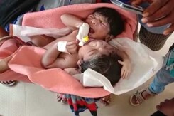 Rare Conjoined Twins Born In Odisha With 2 Heads, 3 Hands Rare Conjoined Twins Born In Odisha With 2 Heads, 3 Hands